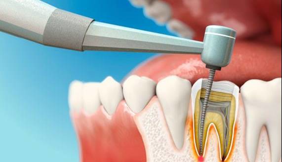 عصب‌کشی درد دارد اما سپر قلب‌تان است!