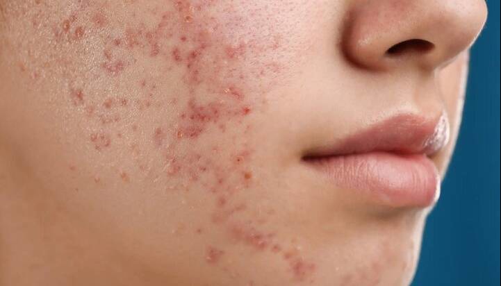 درمان جدید آکنه از راه رسید