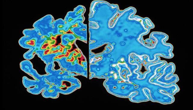 دانشمندان «ساعت آلزایمر» ساختند!